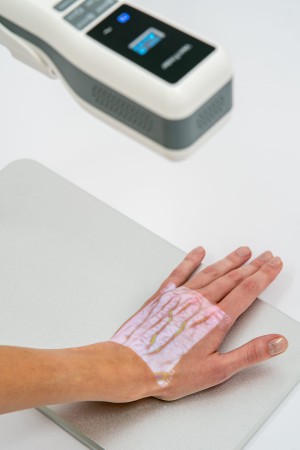 obraz naczyń krwionośnych na powierzchni skóry