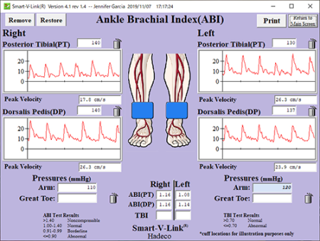 Ankle Brachial Index(ABI) - ABI/TBI interpretation complied with ACC/AHA Guidelines(2005).