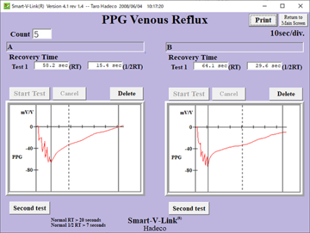 PPG Venous Reflux