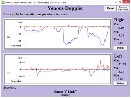 Venous Doppler