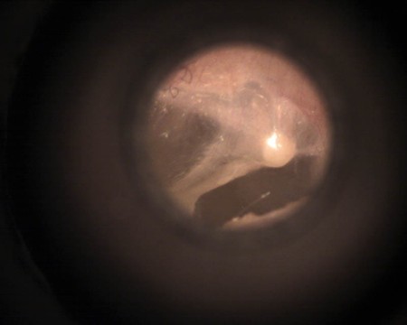 ucho srodkowe badania otoskopowe pediatria praktyka lekarza rodzinnego